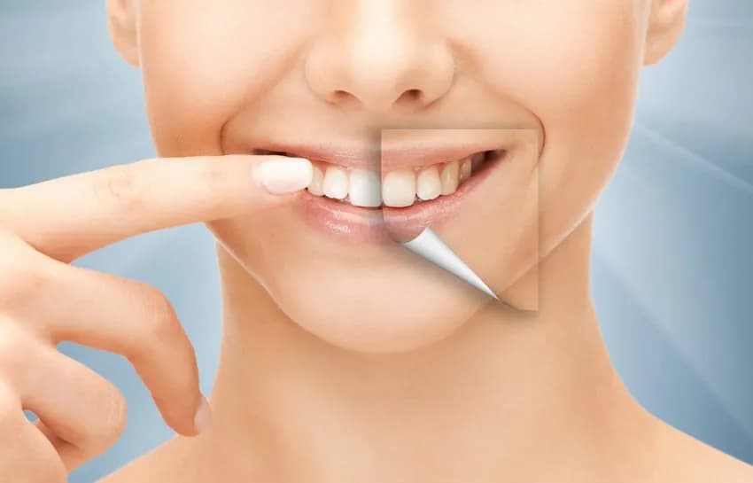 Ile kosztuje Hollywood Smile: kompletny cennik zabiegów w 2025 roku